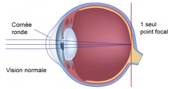 schéma scientifique de l'astigmatisme