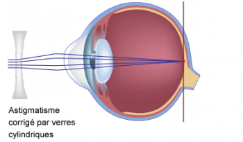 schéma scientifique de l'astigmatisme