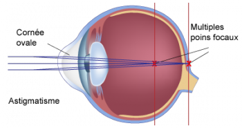 schéma de l'astigmatisme