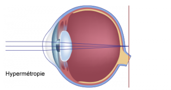 schéma de l'oeil hypermetrope